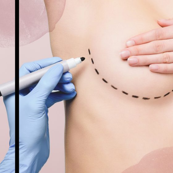 Breast Reduction