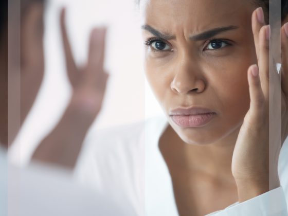 stressed skin